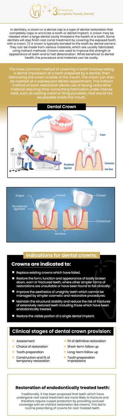 The cost of a new dental crown in San Diego typically ranges from $800 to $1,500. The price may vary based on the specific needs of each patient, including the tooth's location and condition. At 3rd Avenue Complete Family Dental, Dr. Arthur Abordo offers personalized care to ensure that your dental crown is both affordable and high-quality. Our team will work with you to determine the best treatment option, ensuring you receive the best value for your dental care. For more information, contact us or request an appointment online today! We are located at 3330 3rd Avenue Suite 302 San Diego, CA 92103. The cost of a new dental crown in San Diego typically ranges from $800 to $1,500. The price may vary based on the specific needs of each patient, including the tooth's location and condition. At 3rd Avenue Complete Family Dental, Dr. Arthur Abordo offers personalized care to ensure that your dental crown is both affordable and high-quality. Our team will work with you to determine the best treatment option, ensuring you receive the best value for your dental care. For more information, contact us or request an appointment online today! We are located at 3330 3rd Avenue Suite 302 San Diego, CA 92103.